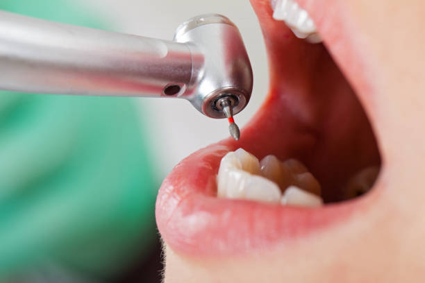 Best Knocked-Out Tooth (Avulsed Tooth) Treatment in Rocky Point, WA